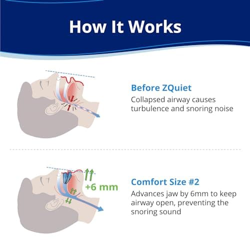 ZQuiet, Anti-Snoring Mouthpiece, Comfort Size#2, Single Refill, Blue Made in USA, BPA-Free, Medical-Grade Material