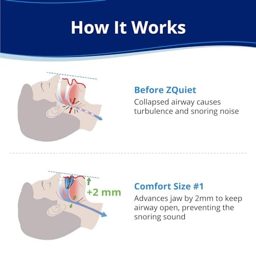 ZQuiet, Anti-Snoring Mouthpiece, Comfort Size #1, Single Refill, Clear, Made in USA, BPA-Free, Medical-Grade Material